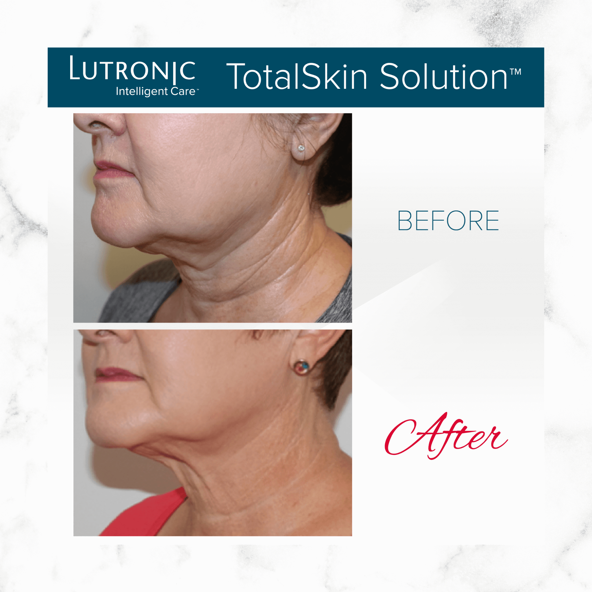 Cahaba Ultimate Skin Package - LaseMD + Genius RF Microneedling