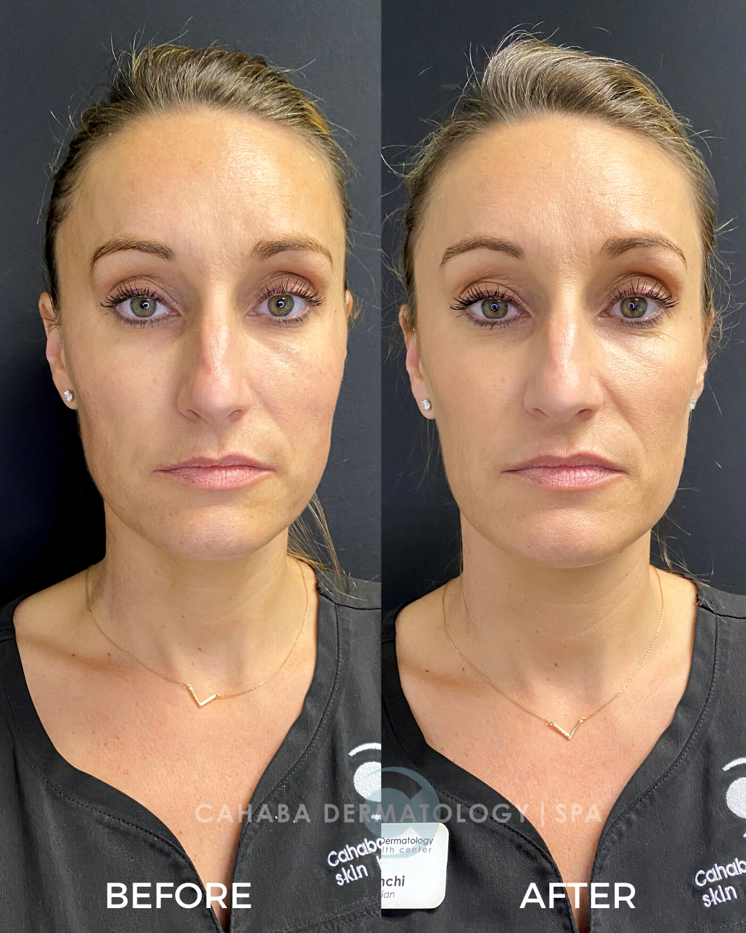 Open House - Sculptra
