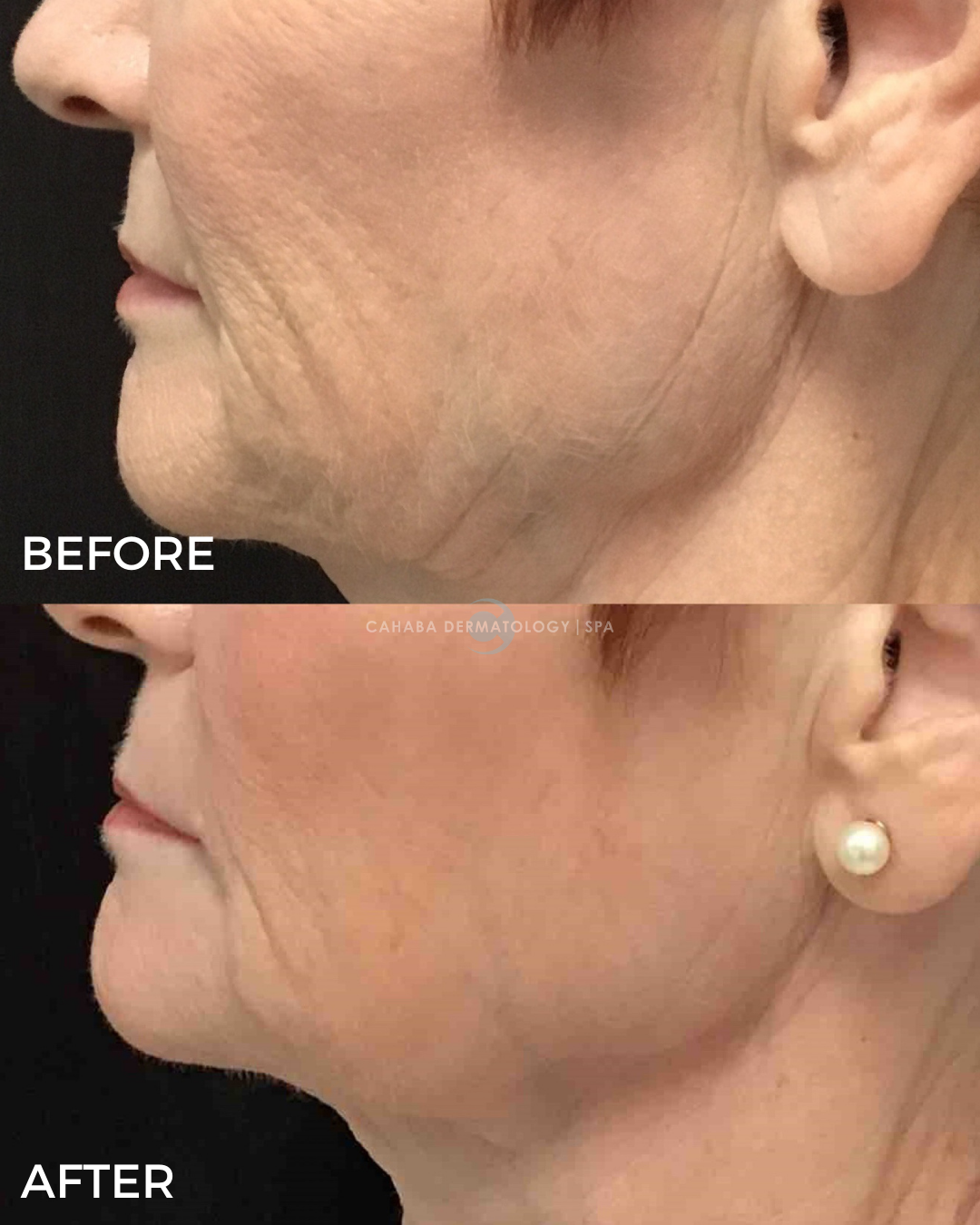 Open House - Sculptra