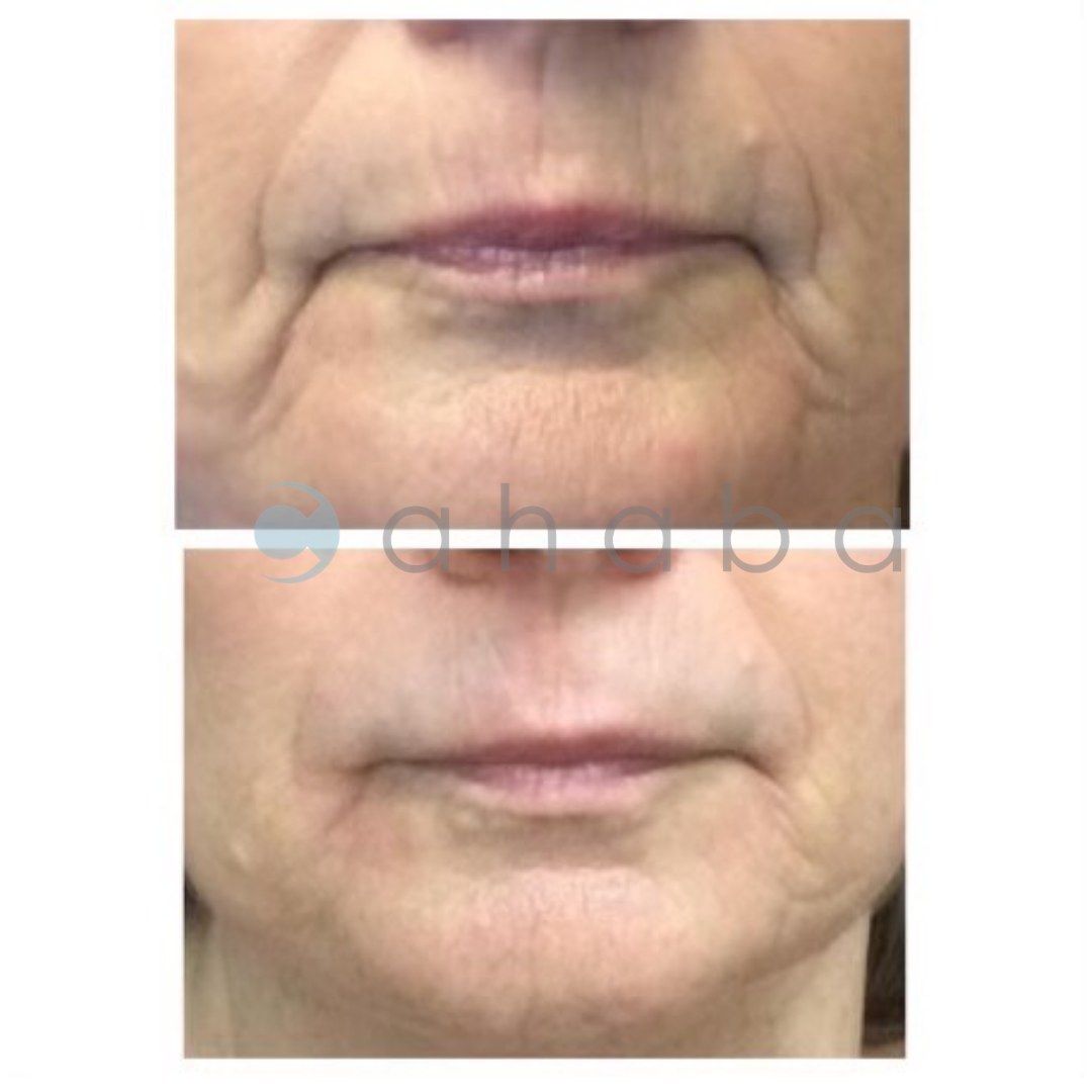 Open House - Restylane