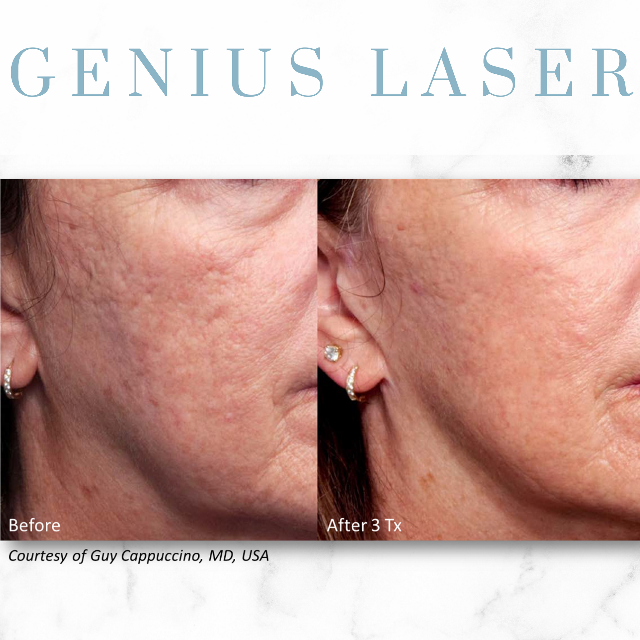 Open House - Genius RF Microneedling