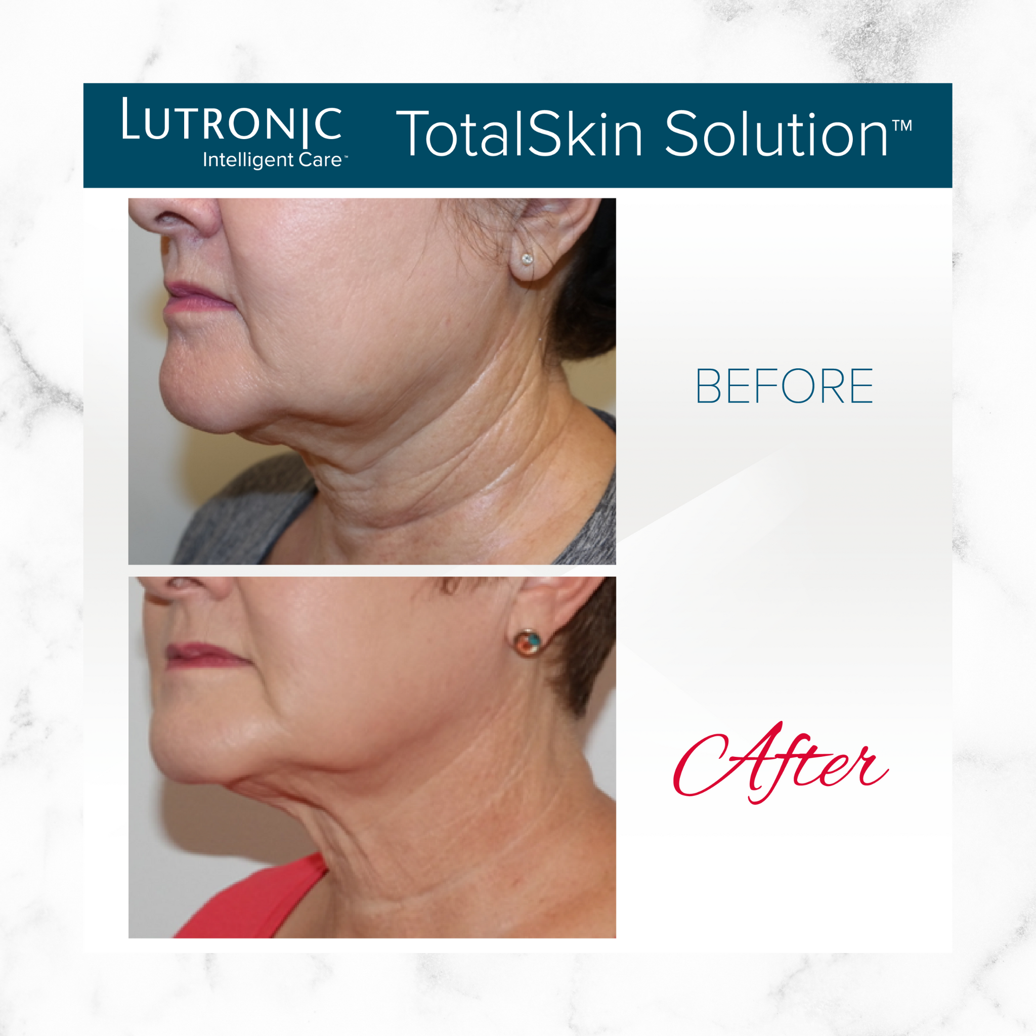 Open House - Cahaba Ultimate Skin Package - LaseMD + Genius RF Microneedling