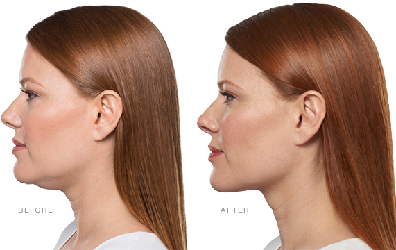 Open House - Kybella