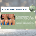 Wish Book - Genius RF Microneedling