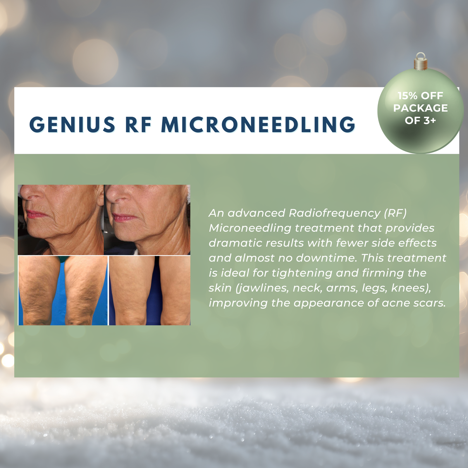 Wish Book - Genius RF Microneedling