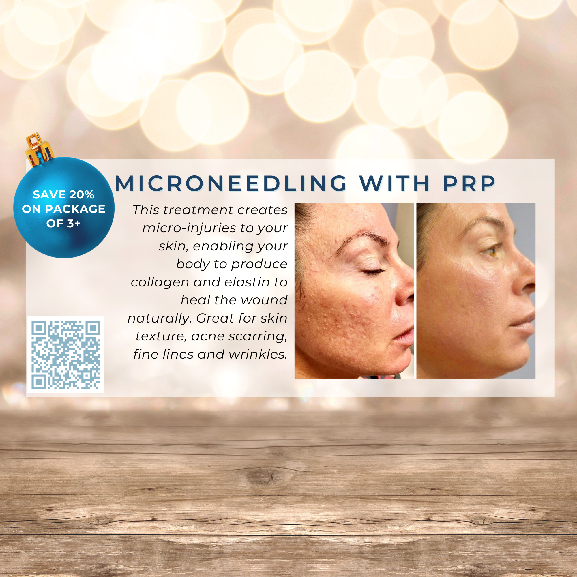 Wish Book - Microneedling with PRP