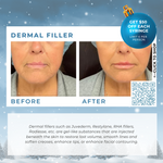 Wish Book - Dermal Filler