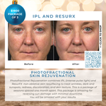 Wish Book - Photofractional Skin Rejuvenation