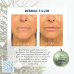 Wish Book - Dermal Filler