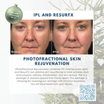 Wish Book - Photofractional Skin Rejuvenation