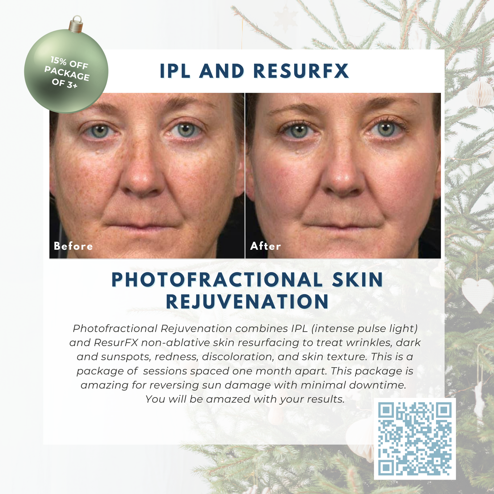 Wish Book - Photofractional Skin Rejuvenation