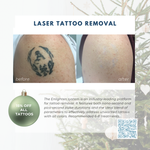 Wish Book - Laser Tattoo Removal