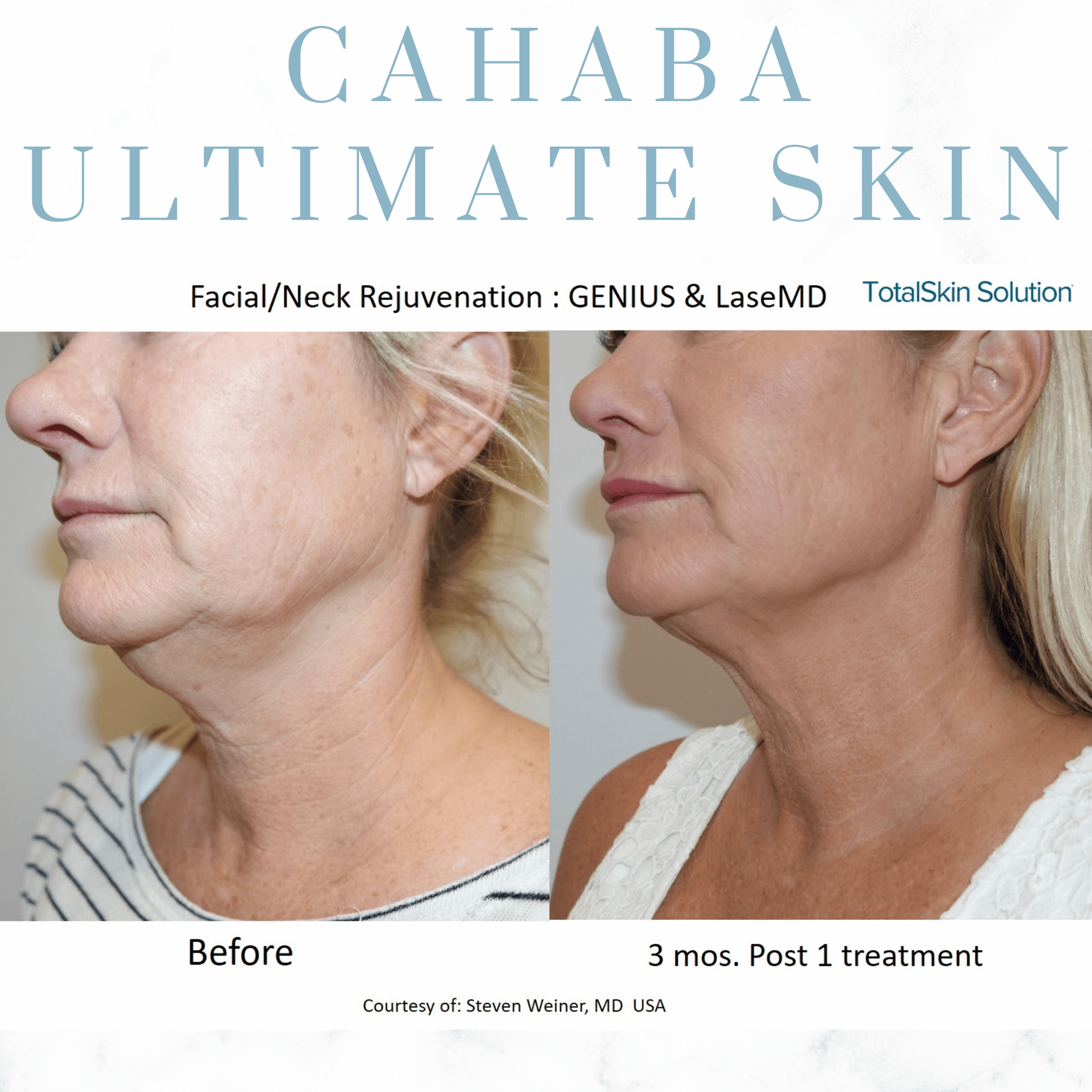 Cahaba Ultimate Skin Package - LaseMD + Genius RF Microneedling