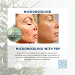 Wish Book - Microneedling with PRP