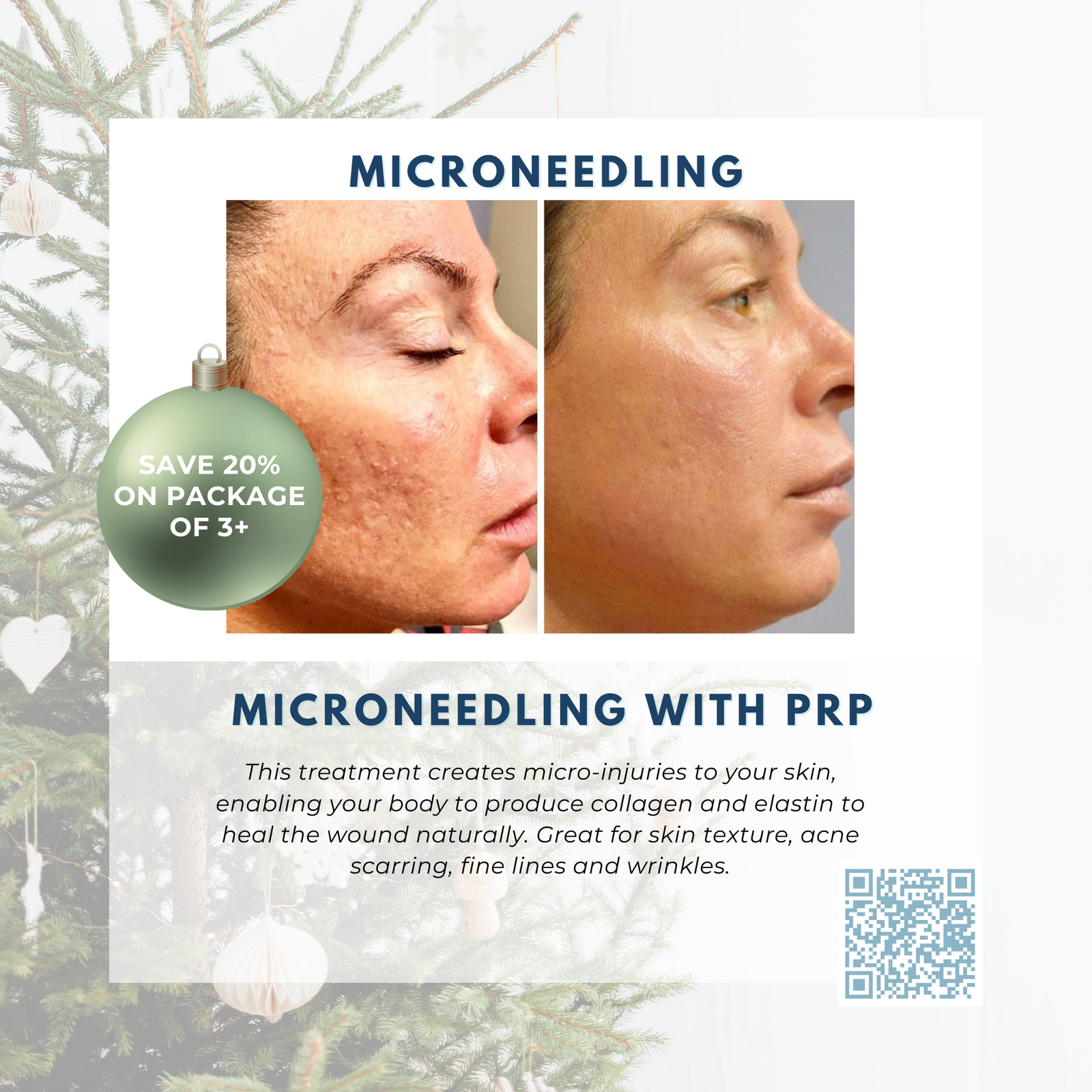 Wish Book - Microneedling with PRP