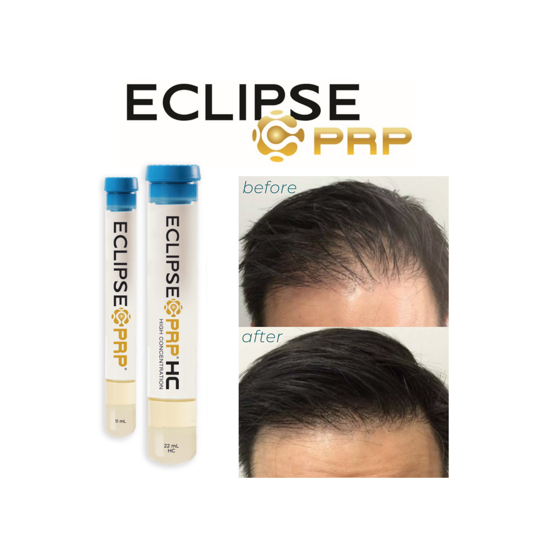 Open House - PRP Hair Restoration