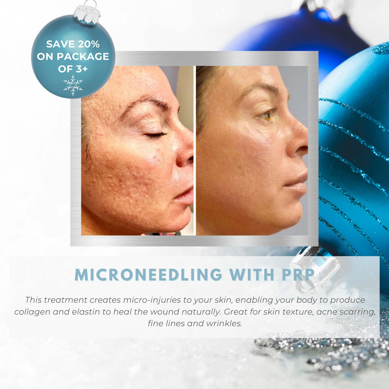Wish Book - Microneedling with PRP