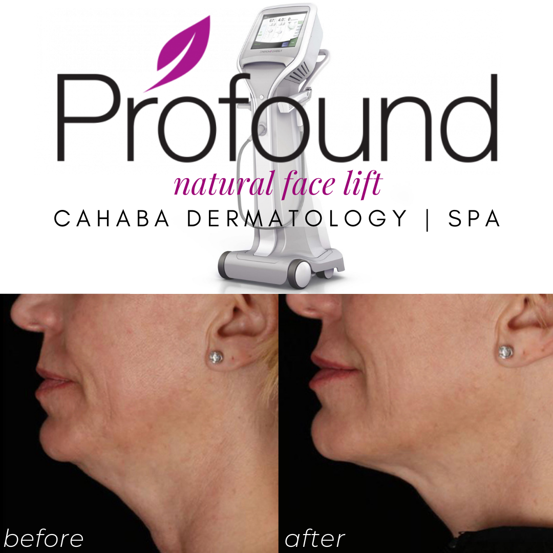 Profound Microneedling Face Treatment – Cahaba Dermatology & Spa