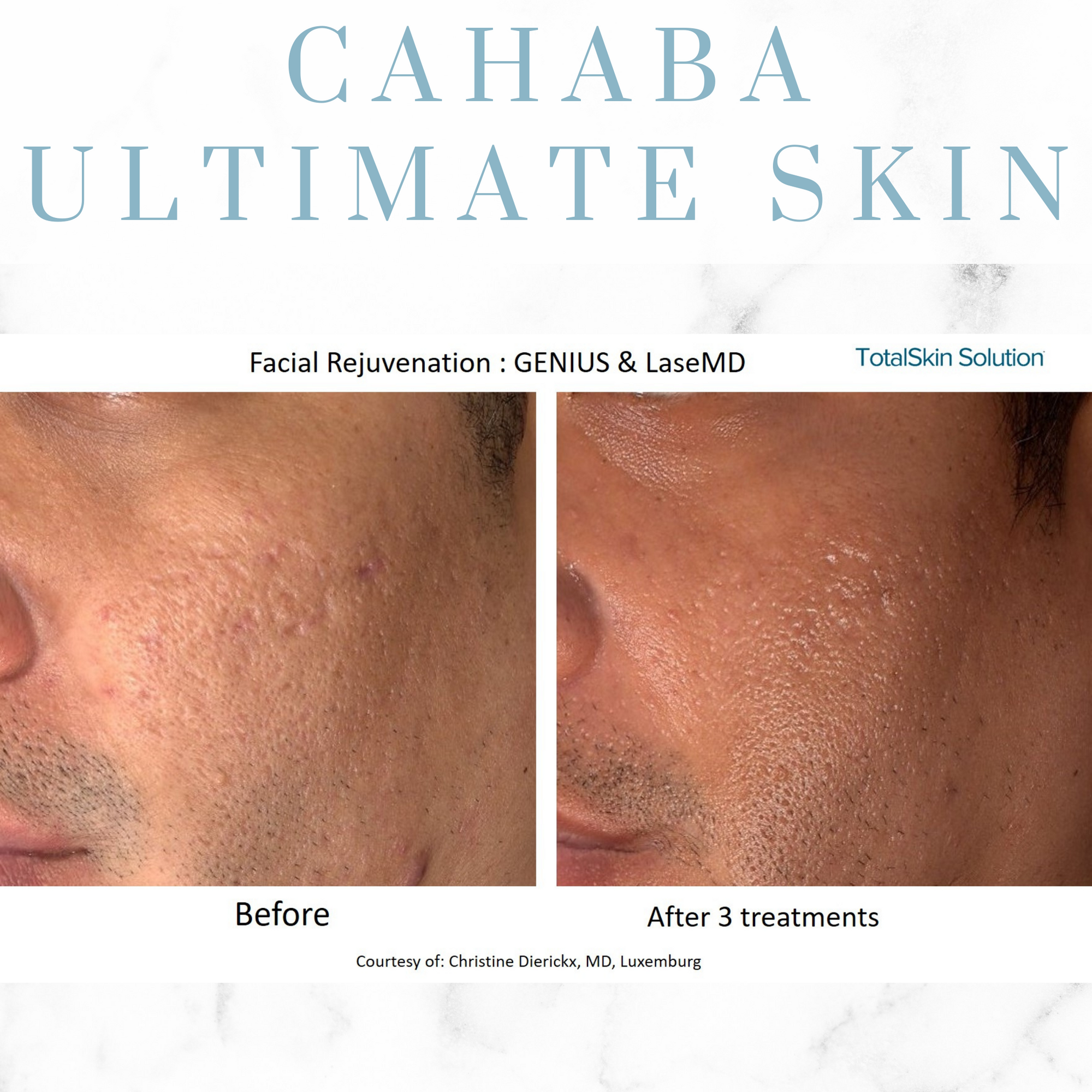 Open House - Cahaba Ultimate Skin Package - LaseMD + Genius RF Microneedling
