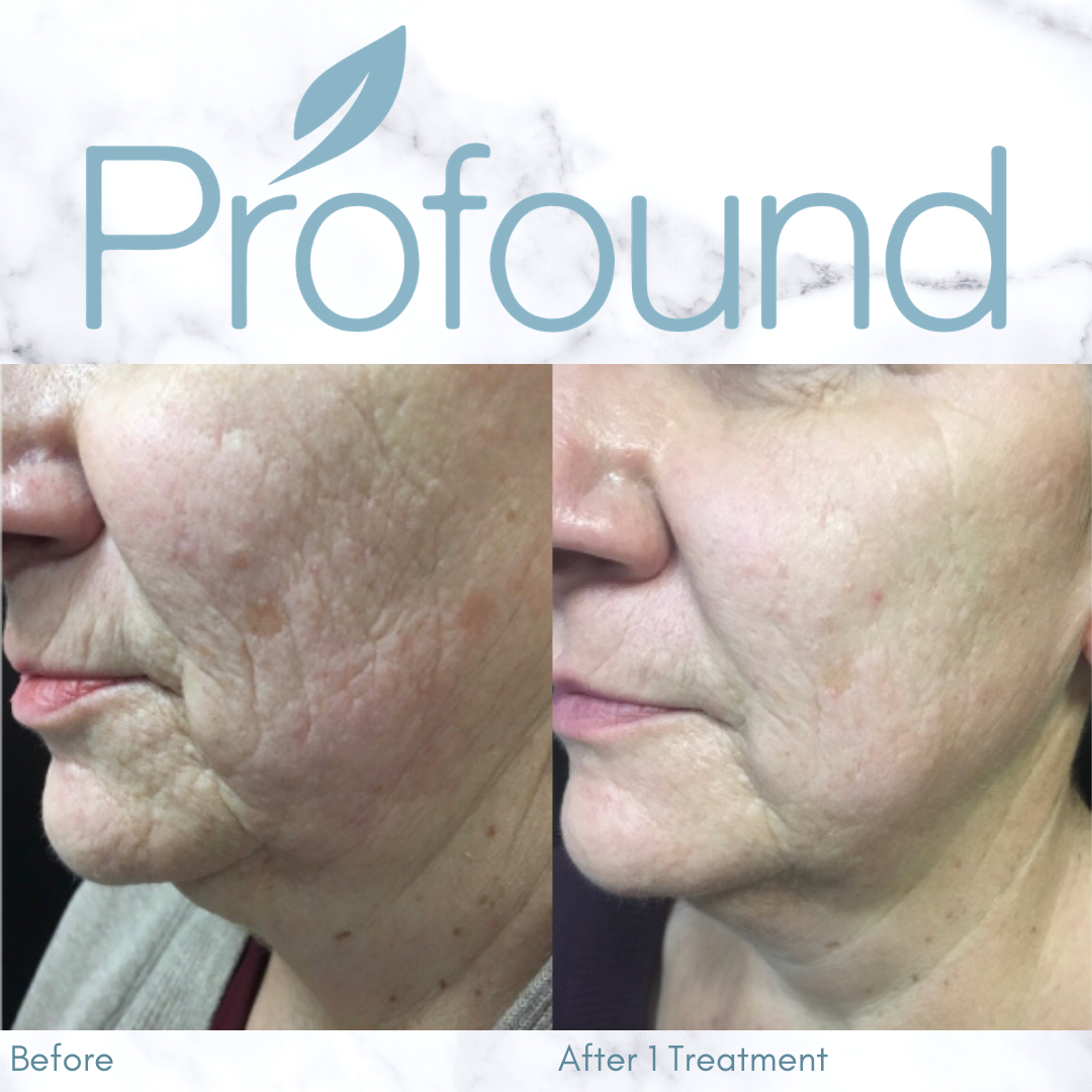 Profound Microneedling Face Treatment